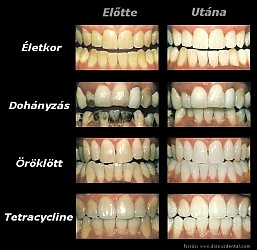 Életkor / Dohányzás / Öröklött / Tetracycline - Dr. Dicsőfi Sándor Zsolt, fogorvos, Miskolc
